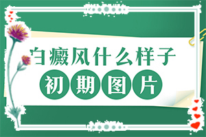 白癜风该怎么治疗(要当心什么)白癜风该怎么治疗