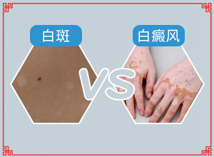[仁心仁术]白癜风治疗要做308吗-白殿病的治疗方法