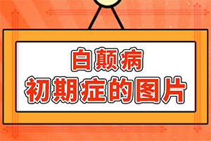 「健康周刊」白毛病简单治疗？白颠疯治疗方法