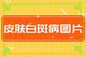 特定电磁波治疗器国仁牌治疗白癫疯？会怎么样