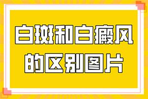 脸上有白斑怎么治-白癞风能治疗吗-有效治疗白癜风