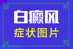 哪个医院治疗白癜风好,白斑病应该如何治疗(能尽快治疗好吗)