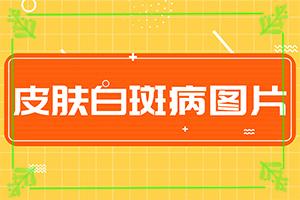 特定电磁波治疗器治疗白癫疯？会怎么样